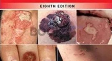 Fitzpatrick’s Color Atlas and Synopsis of Clinical Dermatology 8th Edition PDF Free Download
