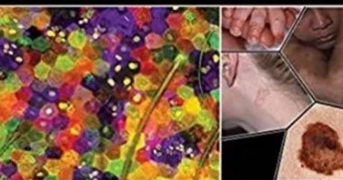 Fitzpatrick’s Dermatology 9th Edition PDF Free Download